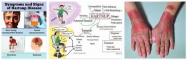 Hartnup Disease