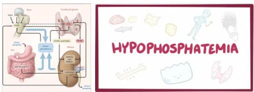 Hypophosphatemia